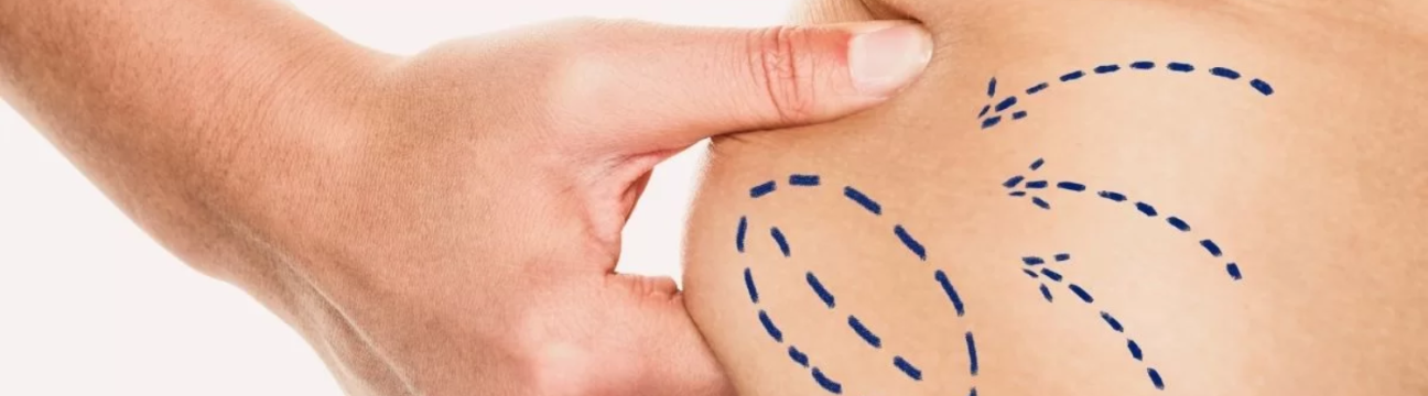 Liposuction Surgery